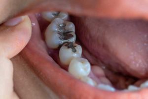 Dentist Fillings
